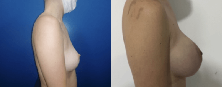 Mamoplastia Medellin Antes Y Despues 44