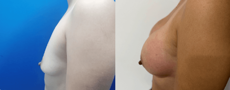 Mamoplastia Medellin Antes Y Despues 45