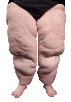 Lipedema